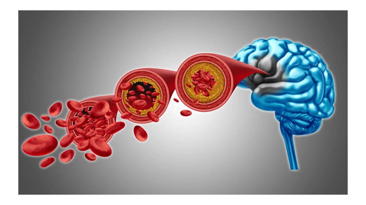 Cientistas descobrem método para recuperar fluxo sanguíneo cerebral na demência