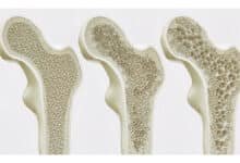 Nova descoberta pode fortalecer ossos sem necessidade de exercícios físicos