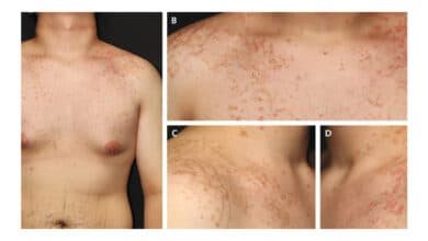 Relação entre dieta cetogênica e erupção cutânea intriga especialistas
