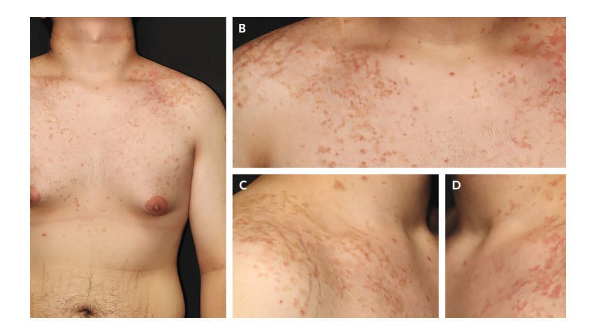 Relação entre dieta cetogênica e erupção cutânea intriga especialistas
