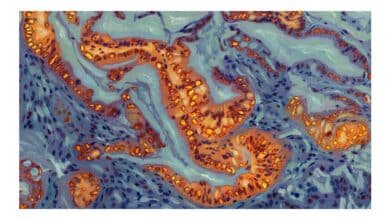 Cientistas identificam gene que torna câncer de pâncreas resistente à quimioterapia