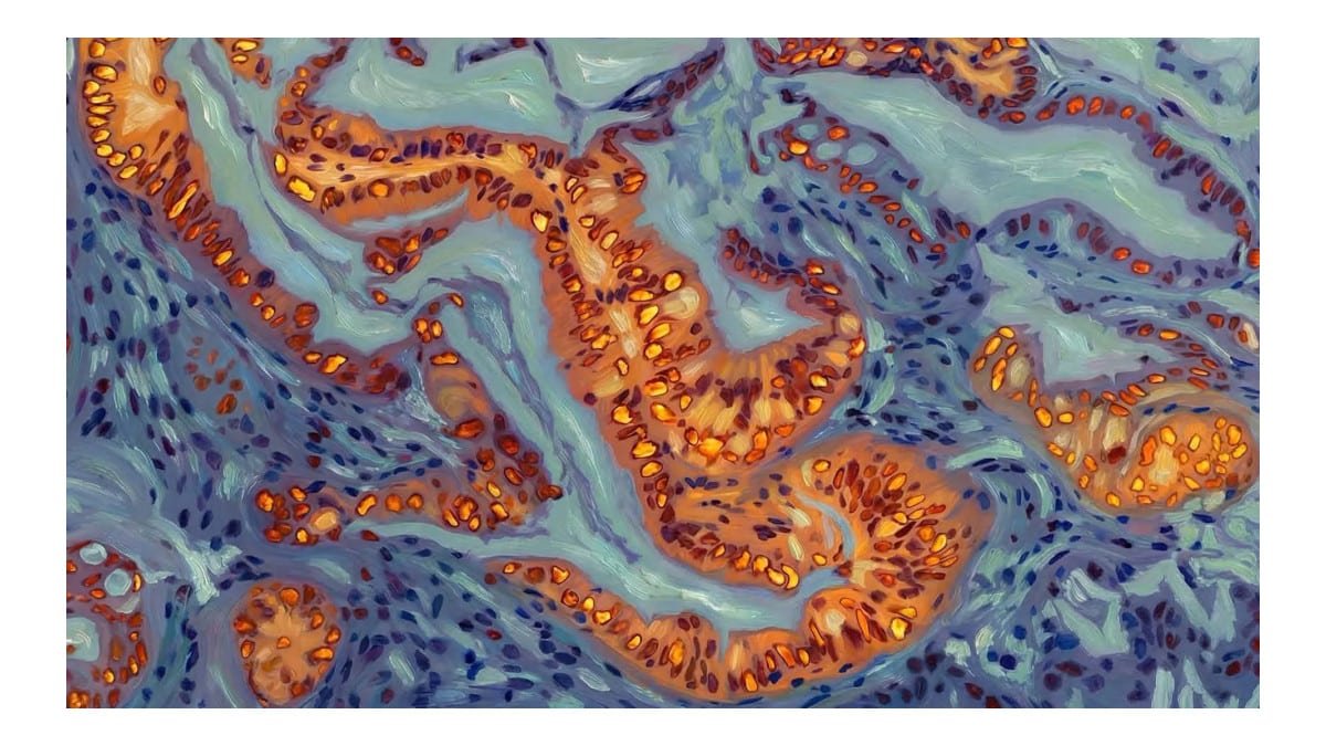 Cientistas identificam gene que torna câncer de pâncreas resistente à quimioterapia