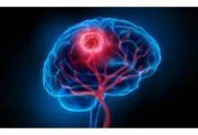 Cientistas identificam células cerebrais que favorecem avanço do câncer