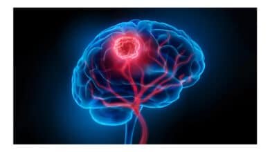 Cientistas identificam células cerebrais que favorecem avanço do câncer