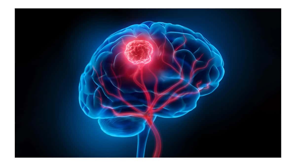 Cientistas identificam células cerebrais que favorecem avanço do câncer